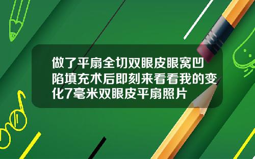做了平扇全切双眼皮眼窝凹陷填充术后即刻来看看我的变化7毫米双眼皮平扇照片