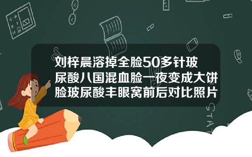 刘梓晨溶掉全脸50多针玻尿酸八国混血脸一夜变成大饼脸玻尿酸丰眼窝前后对比照片