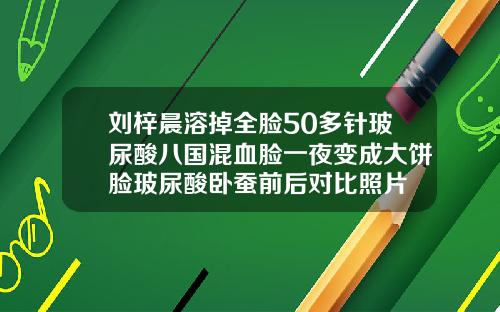 刘梓晨溶掉全脸50多针玻尿酸八国混血脸一夜变成大饼脸玻尿酸卧蚕前后对比照片