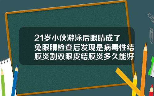 21岁小伙游泳后眼睛成了兔眼睛检查后发现是病毒性结膜炎割双眼皮结膜炎多久能好