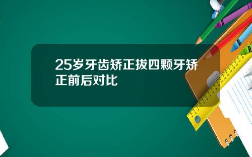 25岁牙齿矫正拔四颗牙矫正前后对比