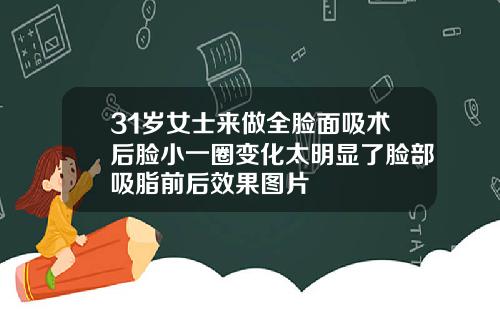 31岁女士来做全脸面吸术后脸小一圈变化太明显了脸部吸脂前后效果图片